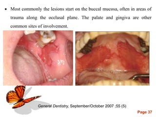 Page 37
 Most commonly the lesions start on the buccal mucosa, often in areas of
trauma along the occlusal plane. The palate and gingiva are other
common sites of involvement.
General Dentistry, September/October 2007 ;55 (5)
 