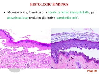 Page 39
 Microscopically, formation of a vesicle or bullae intraepithelially, just
above basal layer producing distinctive ‘suprabasilar split’.
HISTOLOGIC FINDINGS
 