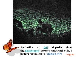 Page 42
Antibodies as IgG deposits along
the desmosomes between epidermal cells, a
pattern reminiscent of chicken wire
 