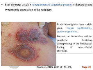 Page 49
 Both the types develop hyperpigmented vegetative plaques with pustules and
hypertrophic granulation at the periphery.
In the intertriginous area – right
groin –brown papillomatous,
erosive vegetations.
Pustules on the surface and the
peripheral blistering
corresponding to the histological
finding of intraepithelial
abscesses.
Courtesy:JDDG; 2010 • 8:179–183
 