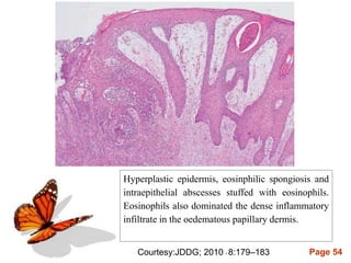 Page 54
Hyperplastic epidermis, eosinphilic spongiosis and
intraepithelial abscesses stuffed with eosinophils.
Eosinophils also dominated the dense inflammatory
infiltrate in the oedematous papillary dermis.
Courtesy:JDDG; 2010 • 8:179–183
 