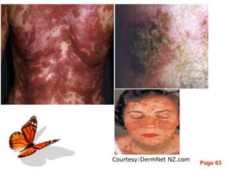 Page 63
Courtesy:DermNet NZ.com
 