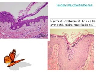 Page 69
Superficial acantholysis of the granular
layer. (H&E, original magnification x40)
Courtesy: http://www.hindawi.com
 