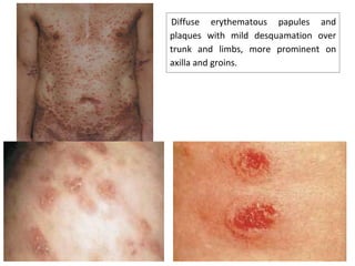 Page 81
Diffuse erythematous papules and
plaques with mild desquamation over
trunk and limbs, more prominent on
axilla and groins.
 