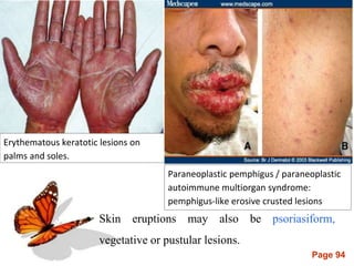 Page 94
Erythematous keratotic lesions on
palms and soles.
Paraneoplastic pemphigus / paraneoplastic
autoimmune multiorgan syndrome:
pemphigus-like erosive crusted lesions
 Skin eruptions may also be psoriasiform,
vegetative or pustular lesions.
 