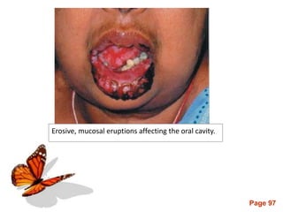 Page 97
Erosive, mucosal eruptions affecting the oral cavity.
 