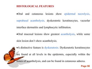 Page 98
HISTOLOGICAL FEATURES
Oral and cutaneous lesions show epidermal necrolysis,
suprabasal acantholysis, dyskeratotic keratinocytes, vacuolar
interface dermatitis and lymphocytic infiltration.
Oral mucosal lesions show greatest acantholysis, while some
skin lesion don’t show acantholysis.
A distinctive feature is dyskeratosis. Dyskeratotic keratinocytes
are found at all levels in the epidermis, especially within the
zones of acantholysis, and can be found in cutaneous adnexa.
 