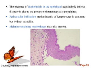 Page 99
 The presence of dyskeratosis in the suprabasal acantholytic bullous
disorder is clue to the presence of paraneoplastic pemphigus.
 Perivascular infiltration predominantly of lymphocytes is common,
but without vasculitis.
 Melanin containing macrophages may also present.
Courtesy: dermaamin.com
 