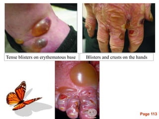 Page 113
Tense blisters on erythematous base Blisters and crusts on the hands
 