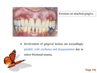 Page 116
Erosions on attached gingiva
 Involvement of gingival lesions are exceedingly
painful, with erythema and desquamation due to
minor frictional trauma.
 