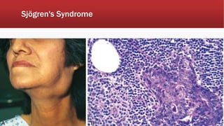 Sjögren's Syndrome
 