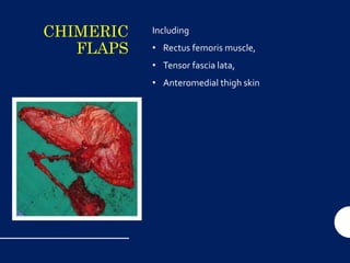 CHIMERIC
FLAPS
Including
• Rectus femoris muscle,
• Tensor fascia lata,
• Anteromedial thigh skin
 
