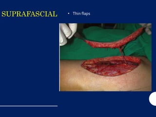 SUPRAFASCIAL • Thin flaps
• Preservation of sensory innervation
 