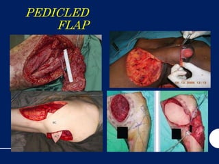 PEDICLED
FLAP
 