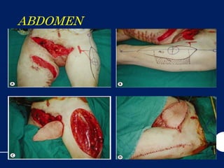 ABDOMEN
AL WALL
DEFECTS
 