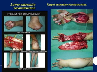 Lower extremity
reconstruction
Upper extremity reconstruction
 
