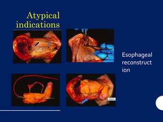 Atypical
indications
for the use
of this flap
Esophageal
reconstruct
ion
 