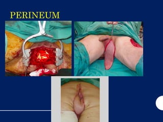 PERINEUM
AND
PENILE
RECONSTR
UCTION
 