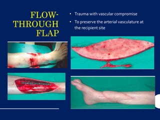 FLOW-
THROUGH
FLAP
• Trauma with vascular compromise
• To preserve the arterial vasculature at
the recipient site
 