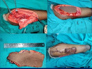 Antero Lateral thigh flap