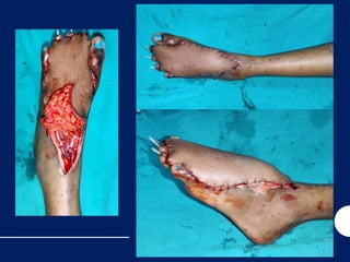 Antero Lateral thigh flap