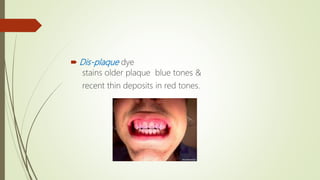  Dis-plaque dye
stains older plaque blue tones &
recent thin deposits in red tones.
 