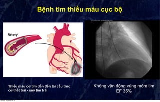 CHẨN ĐOÁN VÀ ĐIỀU TRỊ SUY TIM | PDF