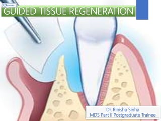 GUIDED TISSUE REGENERATION
Dr. Rinisha Sinha
MDS Part II Postgraduate Trainee
 