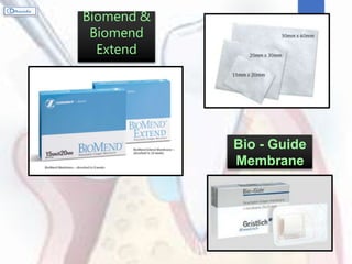 Guided Tissue Regeneration | PPTX