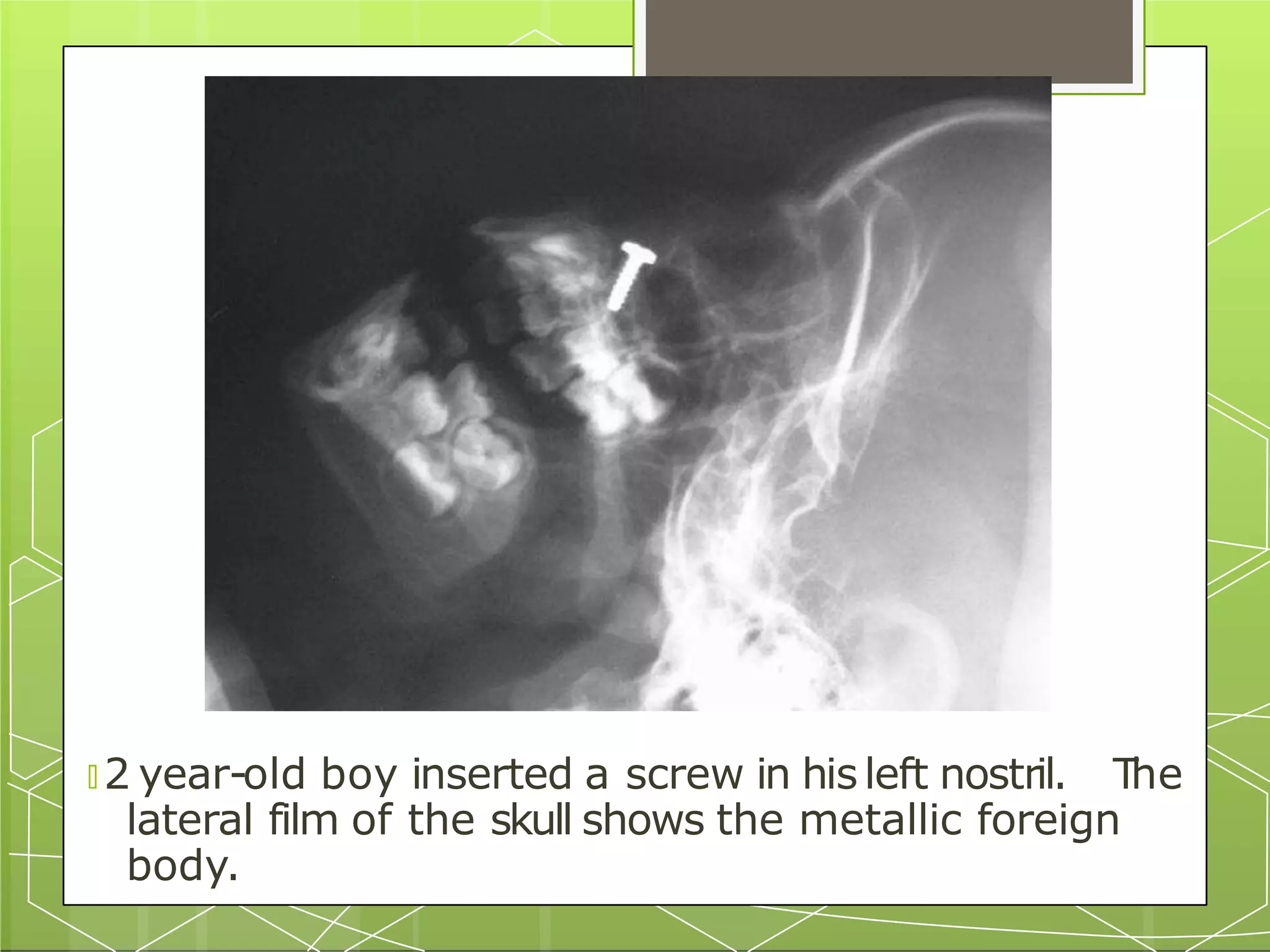 9. AIRWAY FOREIGN BODY.pptx