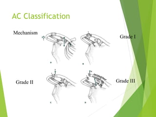 Ac Classification Injuries around the shoulder | PPT