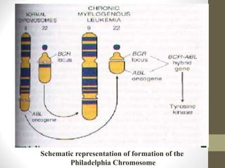 Schematic representation of formation of the
Philadelphia Chromosome
 