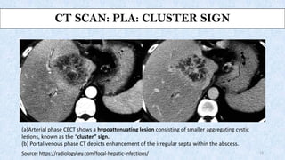 CT SCAN: PLA: CLUSTER SIGN
(a)Arterial phase CECT shows a hypoattenuating lesion consisting of smaller aggregating cystic
...