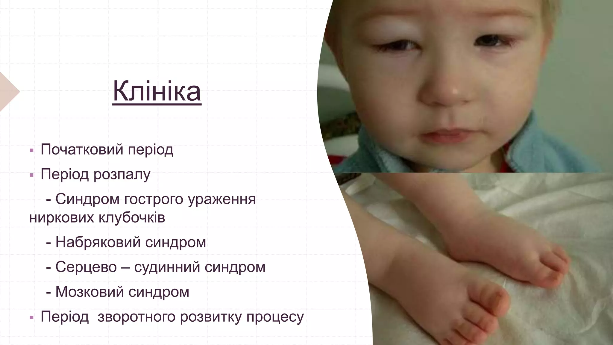 Клініка
 Початковий період
 Період розпалу
- Синдром гострого ураження
ниркових клубочків
- Набряковий синдром
- Серцево – судинний синдром
- Мозковий синдром
 Період зворотного розвитку процесу
 