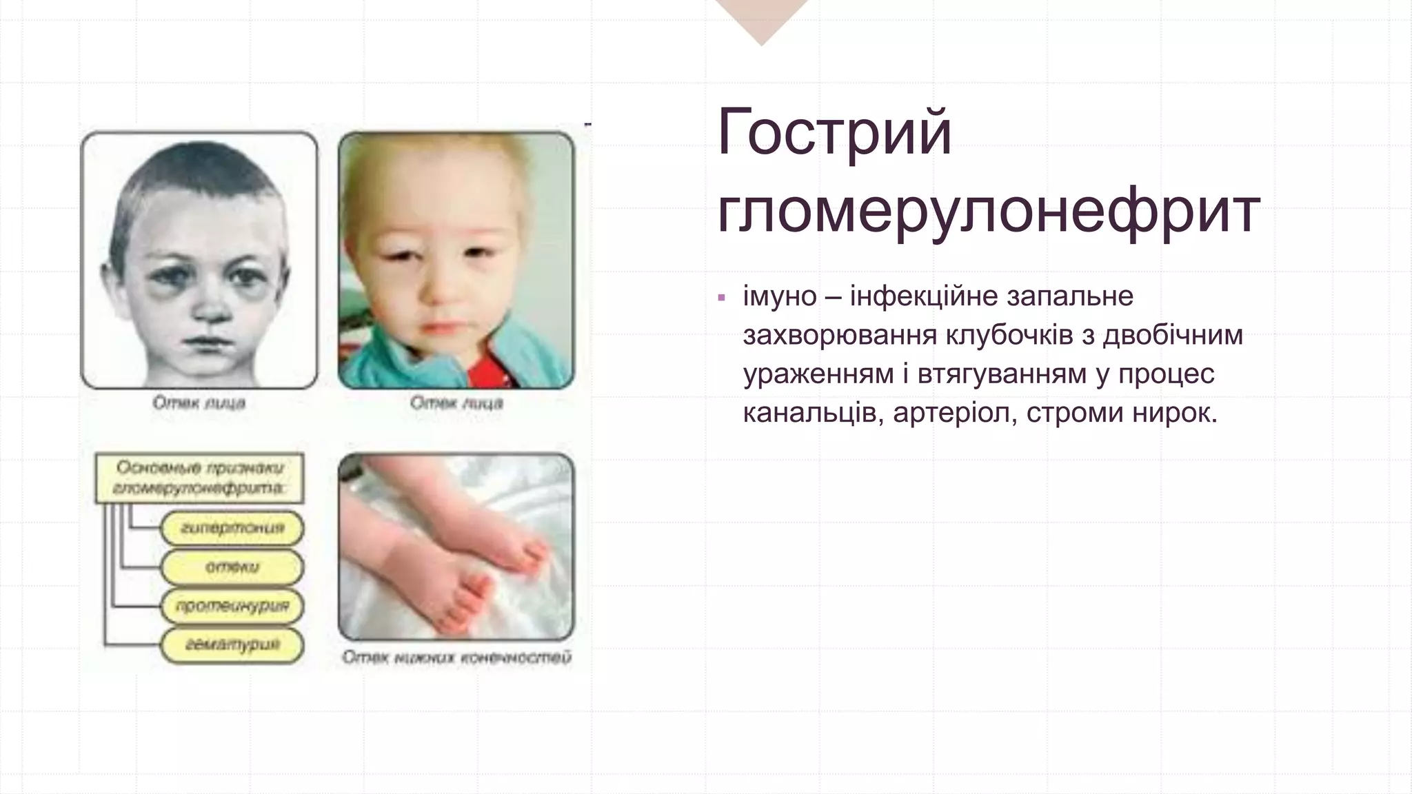 Гострий
гломерулонефрит
 імуно – інфекційне запальне
захворювання клубочків з двобічним
ураженням і втягуванням у процес
канальців, артеріол, строми нирок.
 