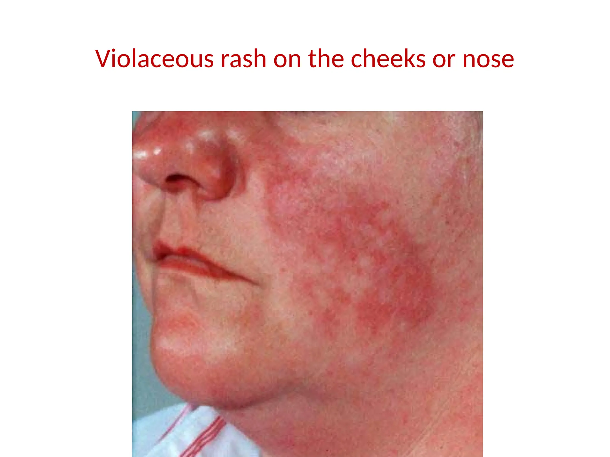 Volaceous Rash Sarcoidosis Respiratory Disease Slide Note | PPTX