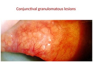 Sarcoidosis Respiratory Disease Slide Note PPTX sarcoidosis-respiratory-disease-slide-note-pptx