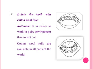  Isolate the tooth with
cotton wool rolls
Rationale: It is easier to
work in a dry environment
than in wet one.
Cotton wool rolls are
available in all parts of the
world.
23
 