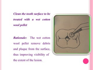 Clean the tooth surface to be
treated with a wet cotton
wool pellet
Rationale: The wet cotton
wool pellet remove debris
and plaque from the surface,
thus improving visibility of
the extent of the lesion.
24
 