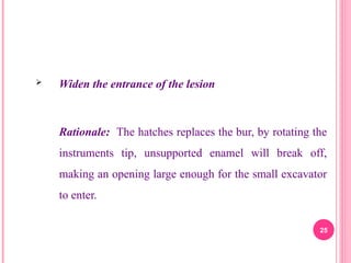  Widen the entrance of the lesion
Rationale: The hatches replaces the bur, by rotating the
instruments tip, unsupported enamel will break off,
making an opening large enough for the small excavator
to enter.
25
 