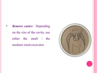  Remove caries: Depending
on the size of the cavity, use
either the small / the
medium sized excavator.
26
 