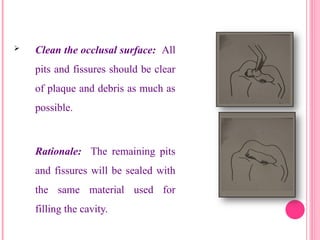  Clean the occlusal surface: All
pits and fissures should be clear
of plaque and debris as much as
possible.
Rationale: The remaining pits
and fissures will be sealed with
the same material used for
filling the cavity.
28
 