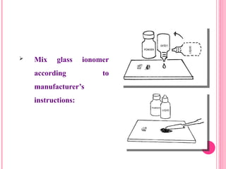  Mix glass ionomer
according to
manufacturer’s
instructions:
31
 