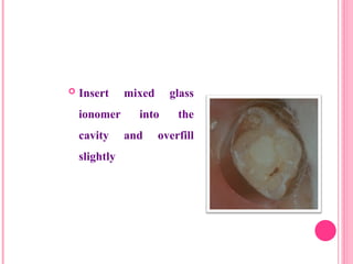  Insert mixed glass
ionomer into the
cavity and overfill
slightly
32
 