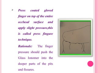  Press coated gloved
finger on top of the entire
occlusal surface and
apply slight pressure,this
is called press fingure
technique.
Rationale: The finger
pressure should push the
Glass Ionomer into the
deeper parts of the pits
and fissures. 33
 