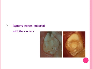  Remove excess material
with the carvers
34
 