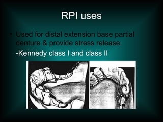 RPI uses
• Used for distal extension base partial
denture & provide stress release.
-Kennedy class I and class II
 