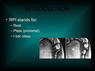 INTRODUCTION
• RPI stands for:
– Rest.
– Plate (proximal).
– I bar clasp.
 