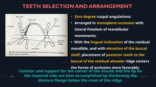 Cuspal Ridges Comprehensive Prosthetic Management and Rehabilitation of ...