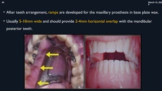 Maxillary Ramps Comprehensive Prosthetic Management and Rehabilitation of ...